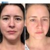 ست لیفتینگ با نخ پروتئین کره ای FaceSculpting - Image 3